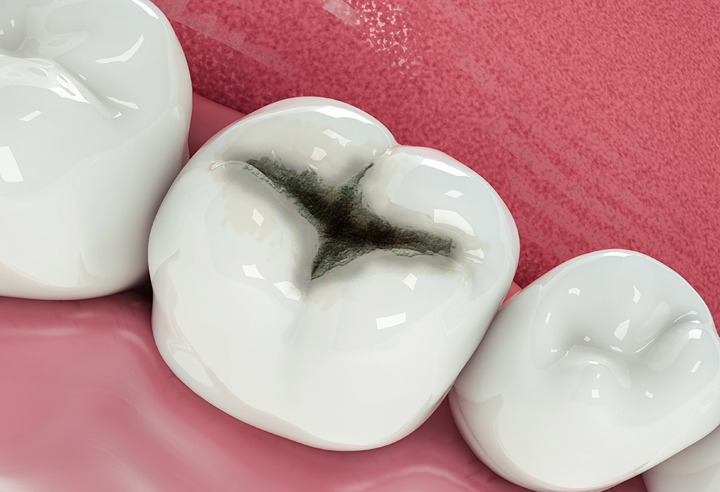 Odontología conservadora en Clínica Dental Medent