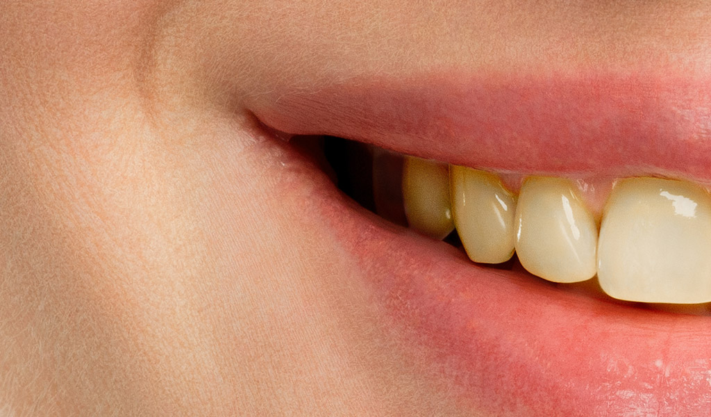 Antes de un blanqueamiento dental