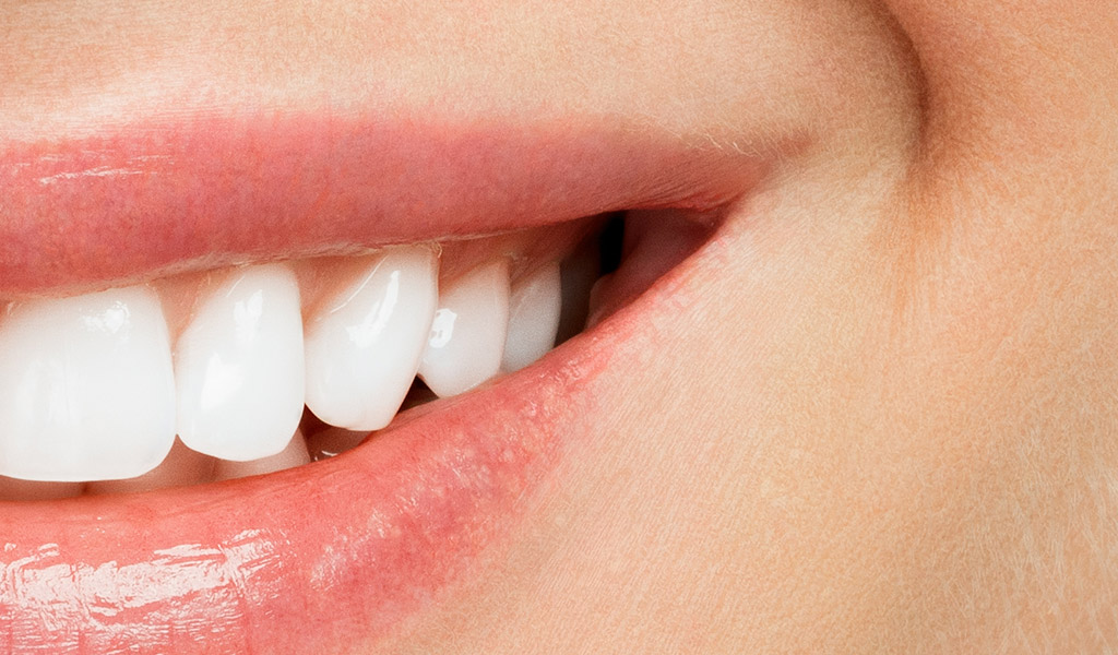 Después de un blanqueamiento dental