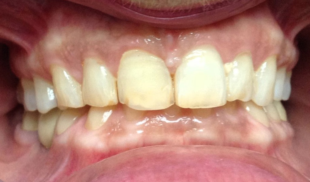 Antes de microcarillas dentales