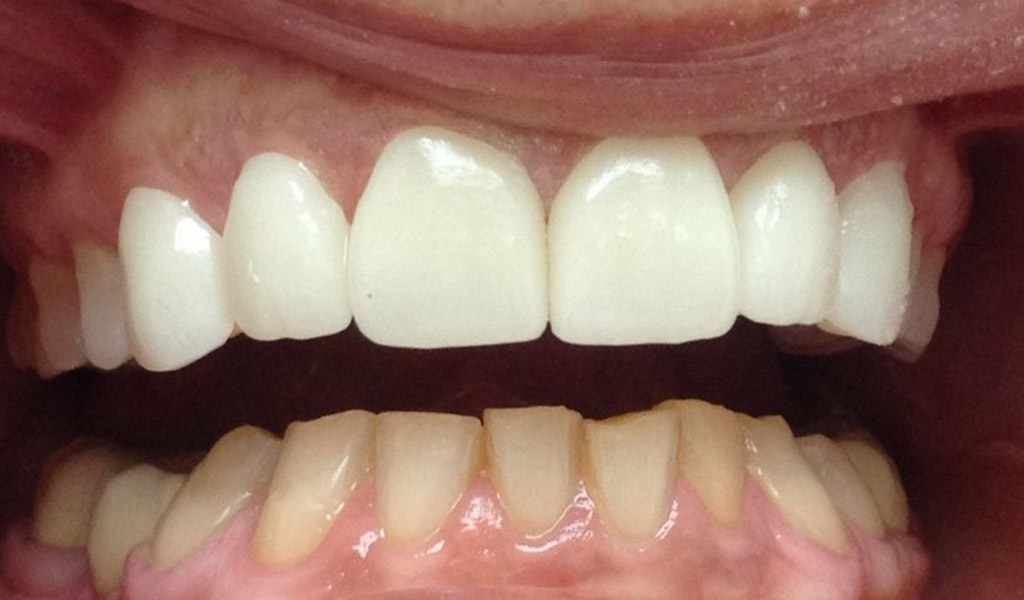 Después de microcarillas dentales