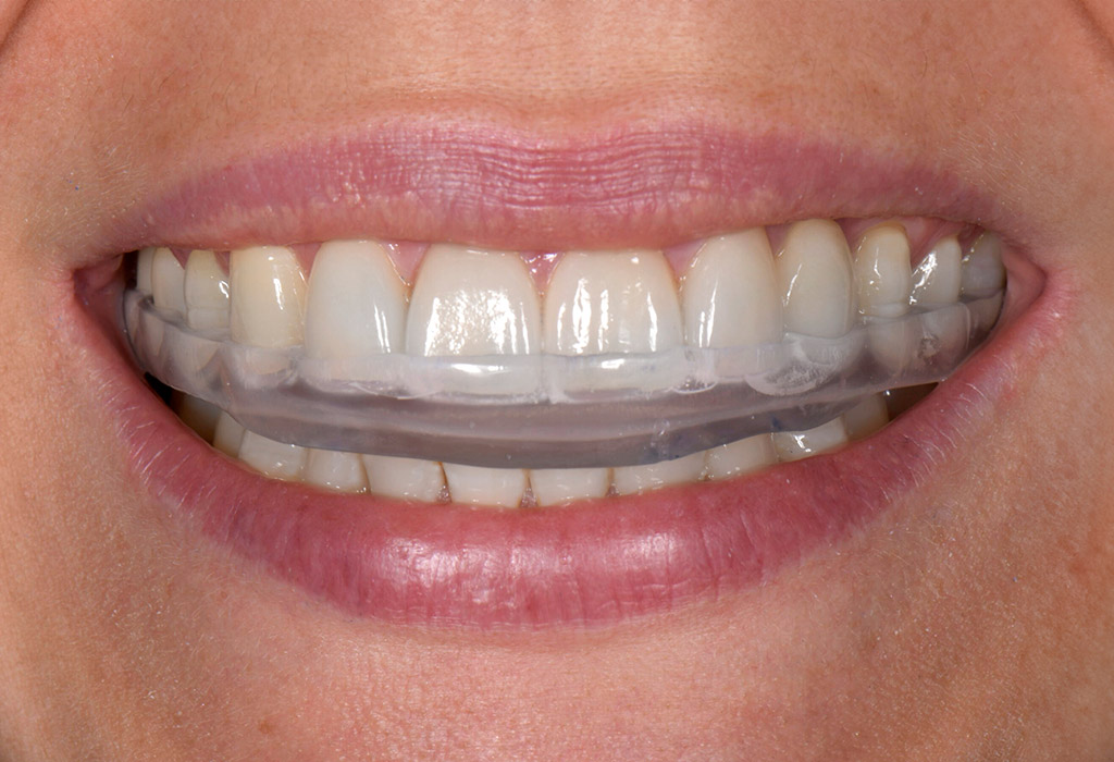 Férulas de descarga en Clínica Dental Medent