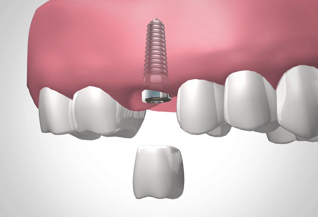 Implante dental en Clínica Dental Medent